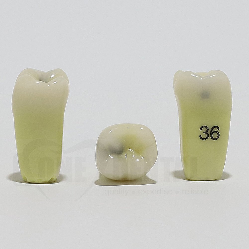Caries Tooth 36MO for ADC Model