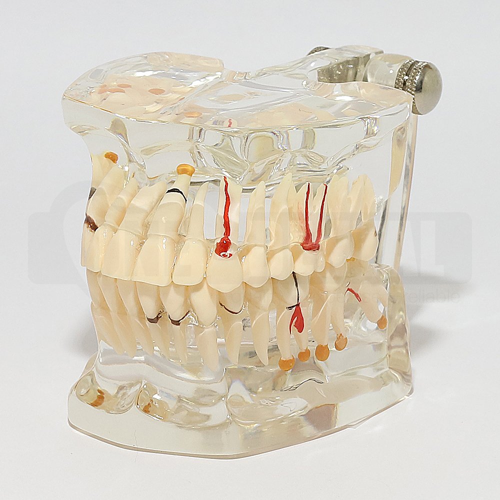 Solid Transparent Adult Model with Extensive Pathologies and Implant
