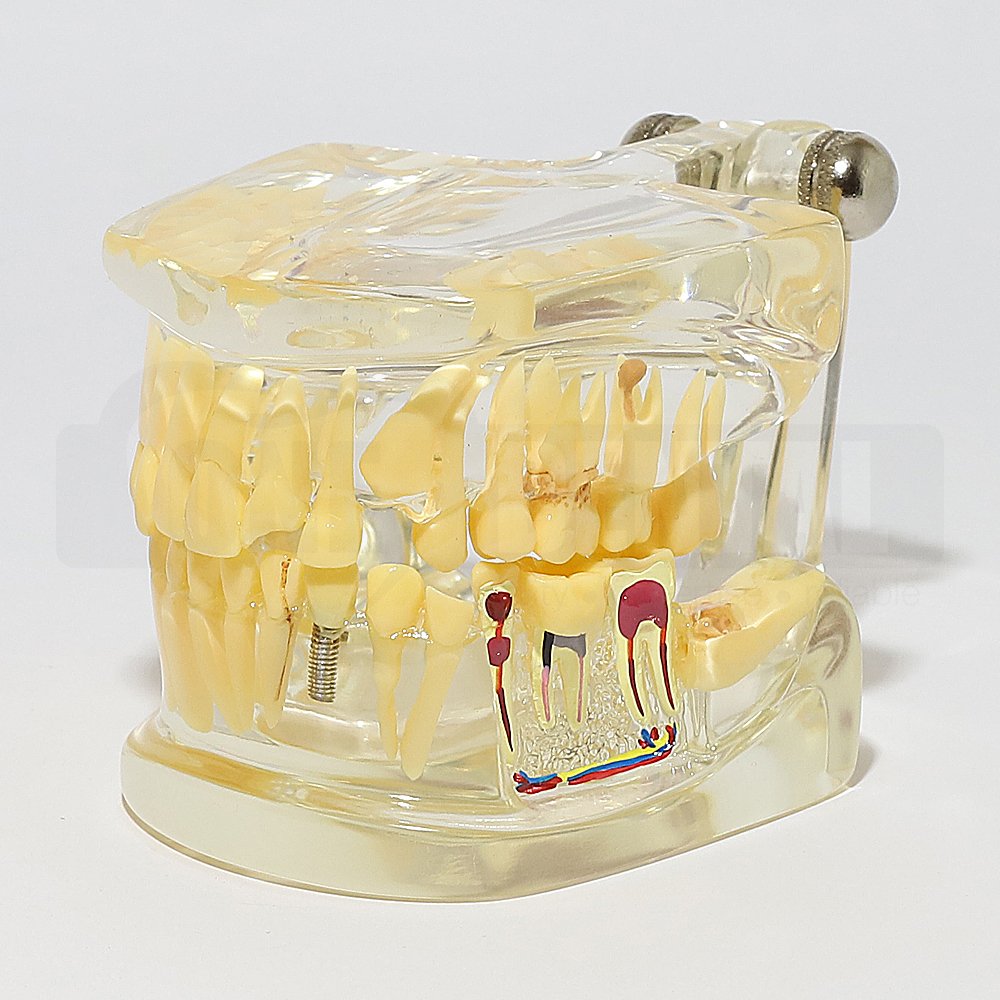 Solid Transparent Adult Model with Pathology, Fractures and Implant