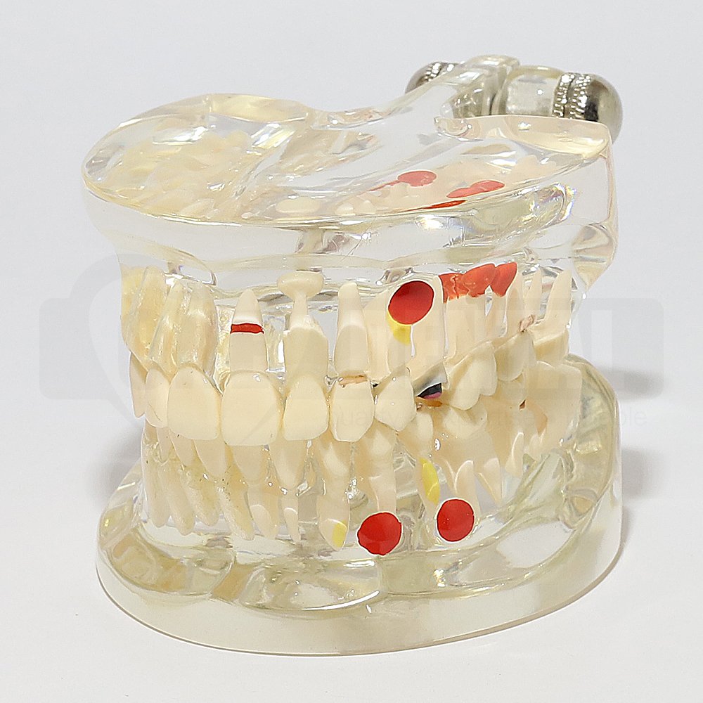 Solid Transparent Adult Model with Pathologies and Removable Teeth