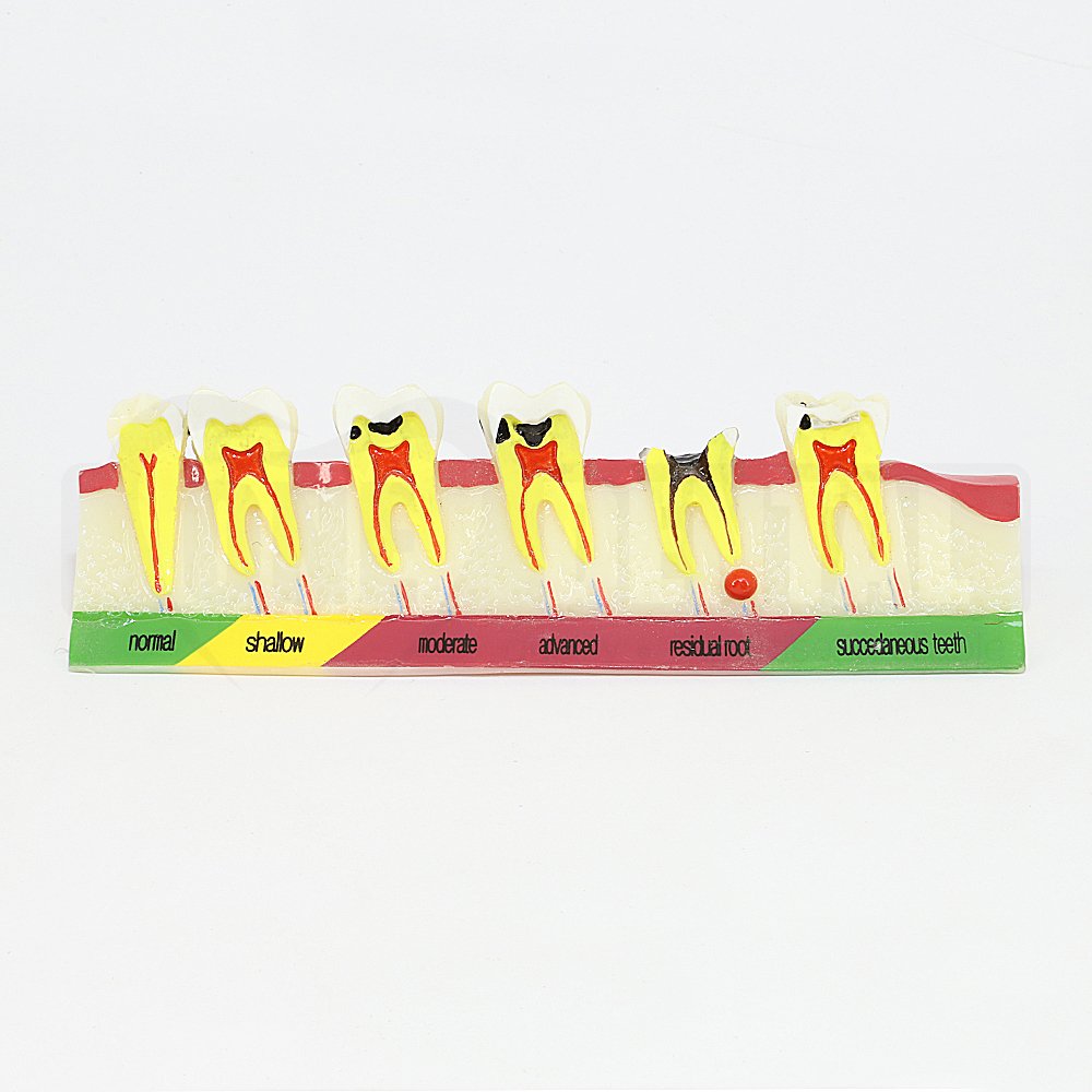 Caries Progression Model with 6 Stages