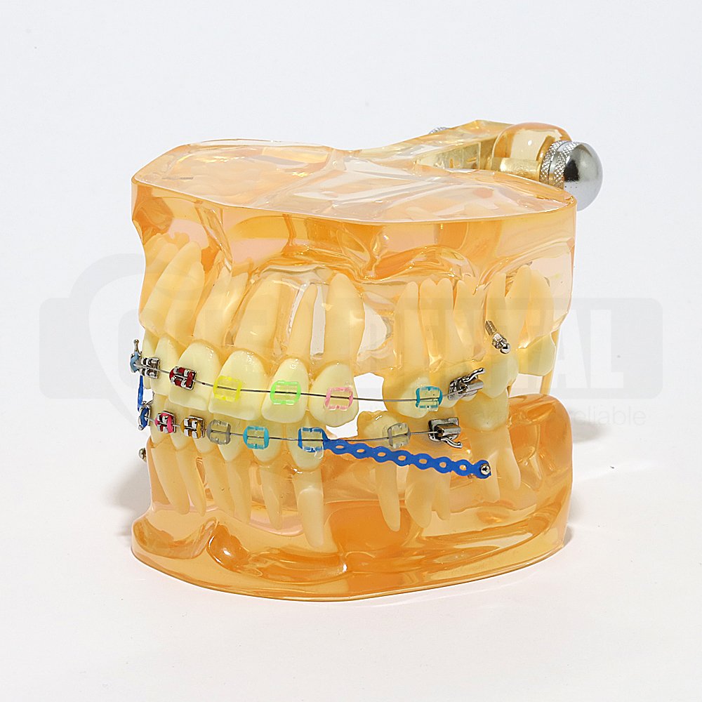 Adult Orthodontic Model Pre Banded with brackets