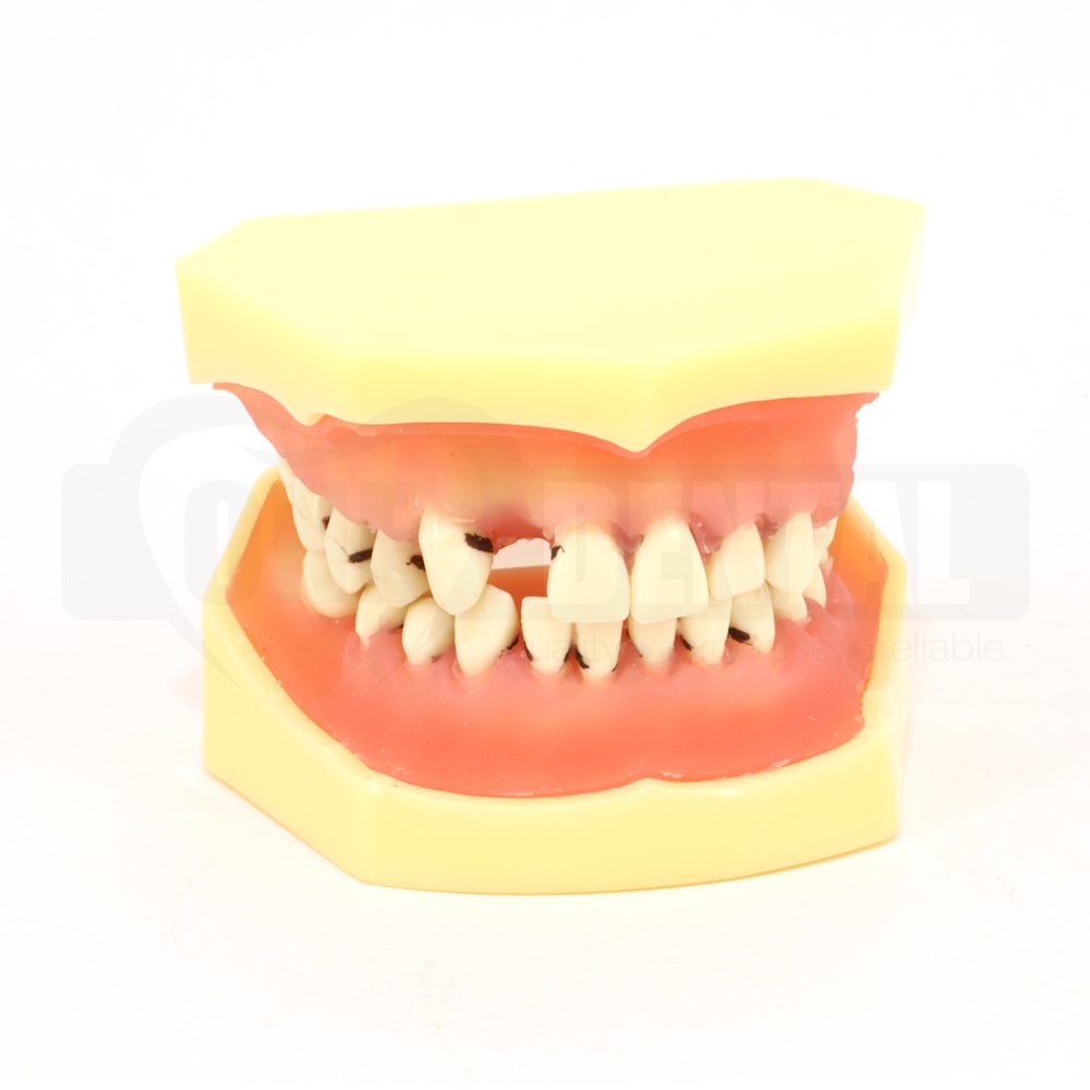 Patient Education Model with Periodontal Disease