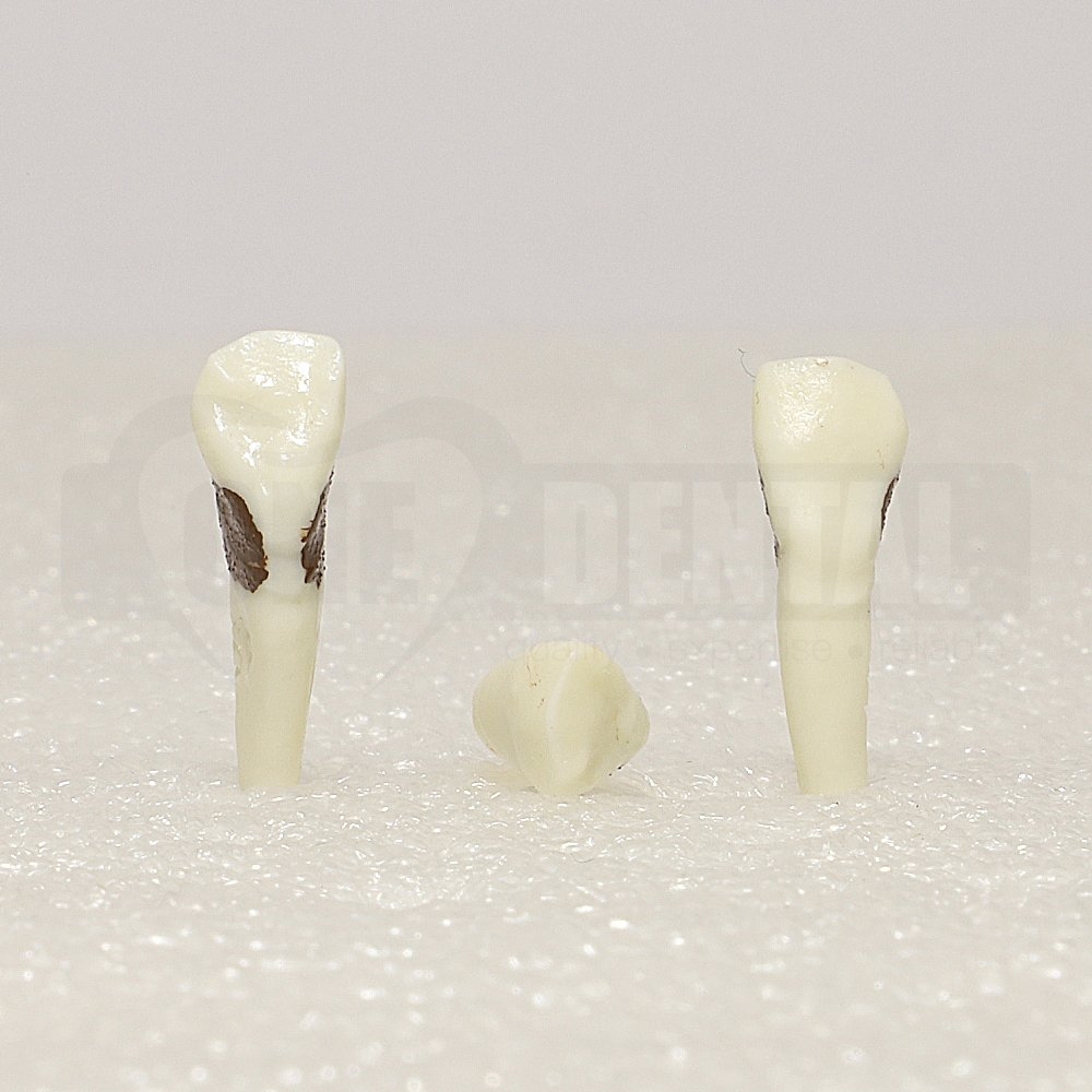 Periodontic Tooth 13 Spahr 19