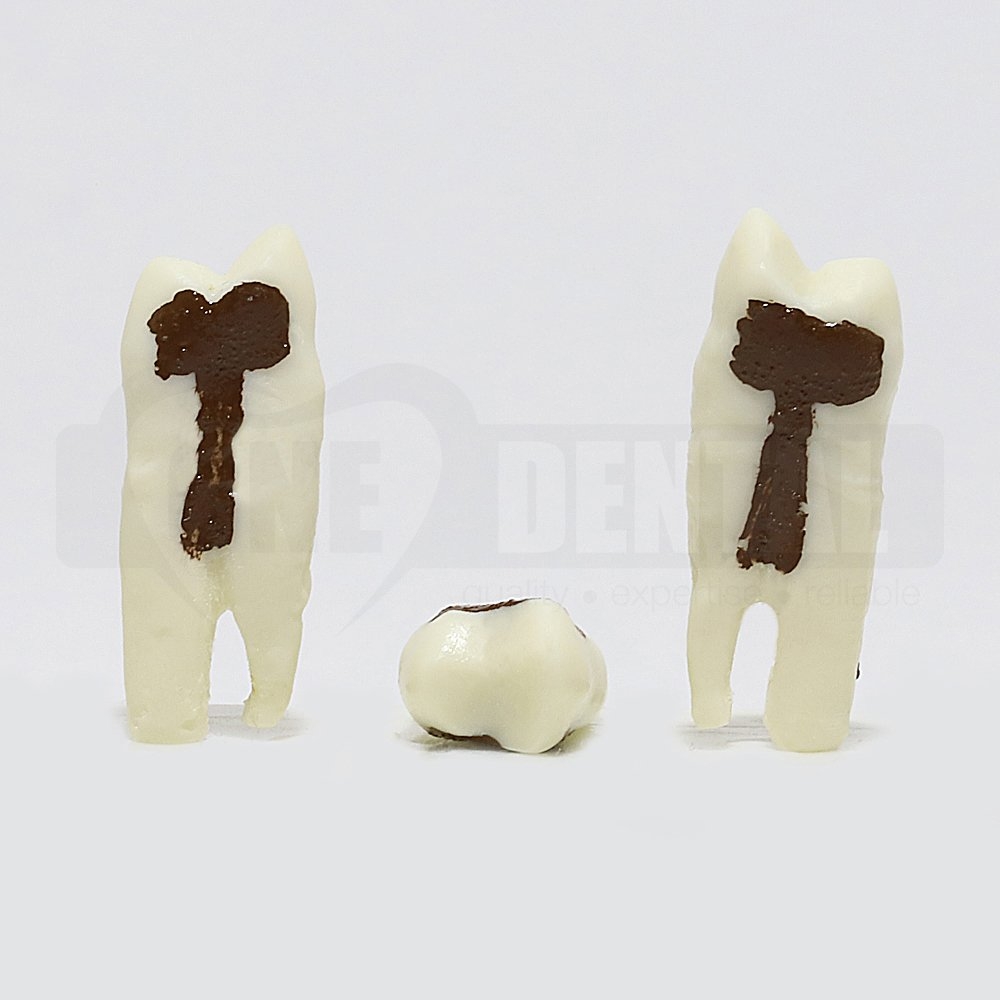 Periodontic Tooth 14
