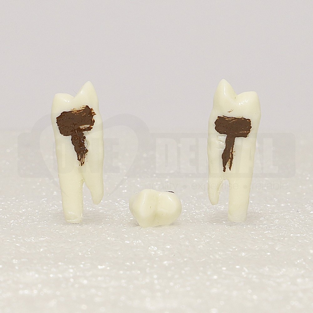 Periodontic Tooth 14 Spahr 19