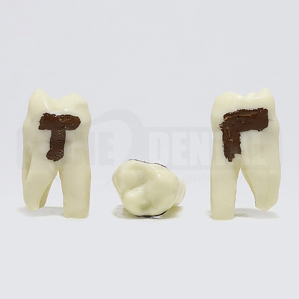 Periodontic Tooth 17