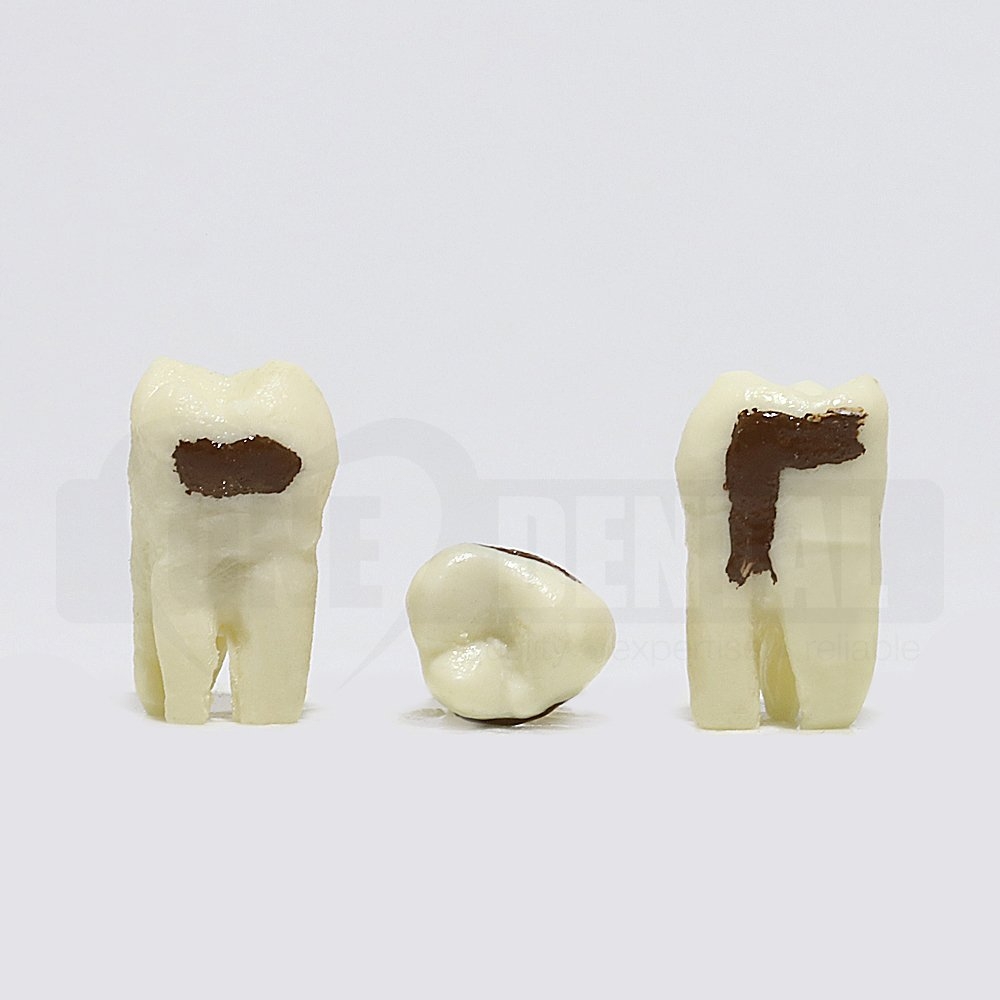 Periodontic Tooth 18