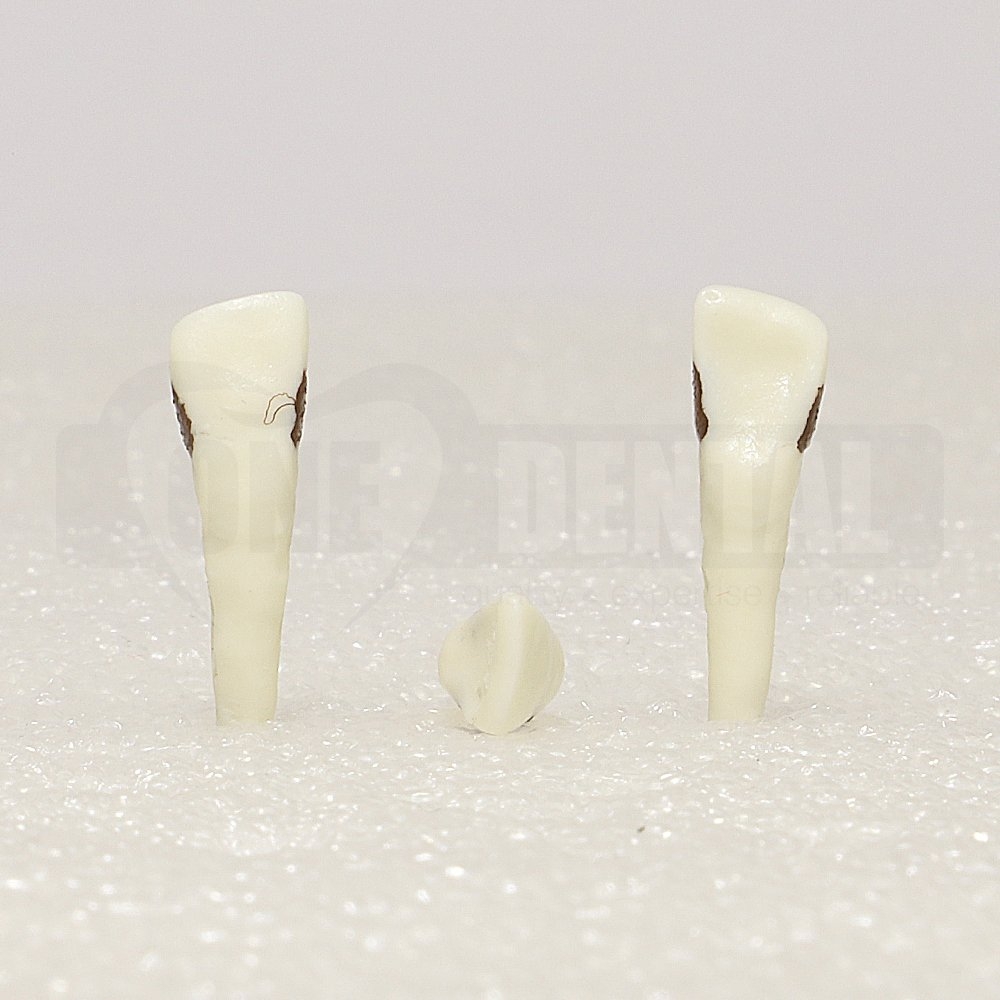 Periodontic Tooth 22 Spahr 19