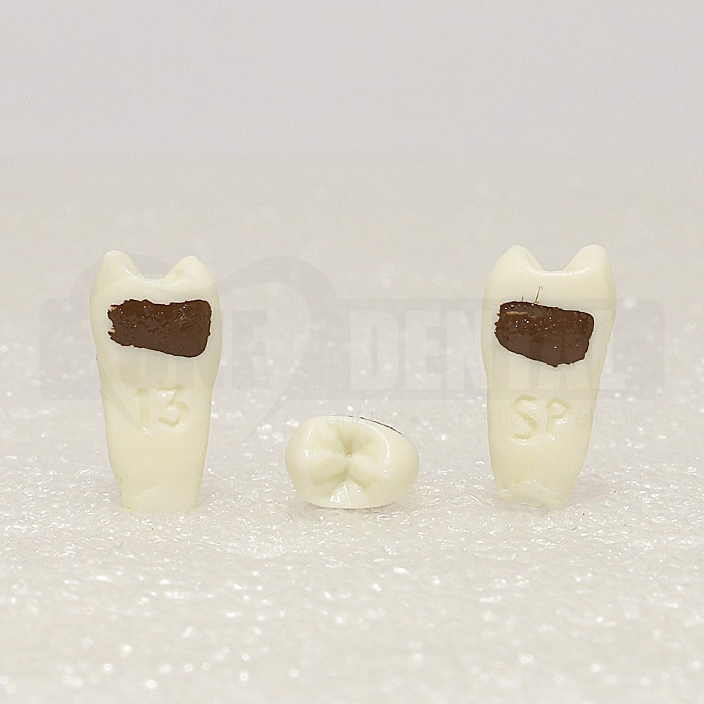Periodontic Tooth 25 Spahr 19