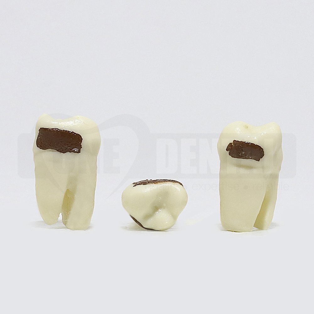 Periodontic Tooth 28