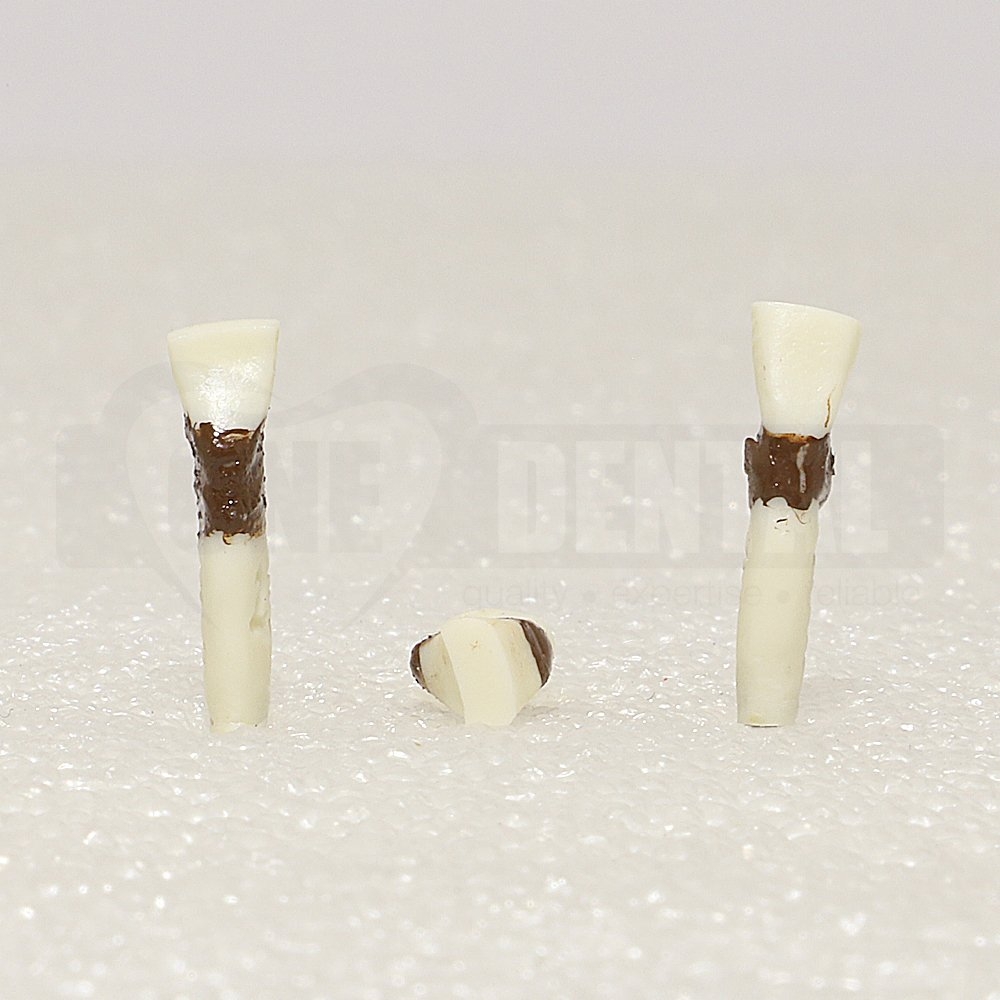 Periodontic Tooth 32 Spahr 19