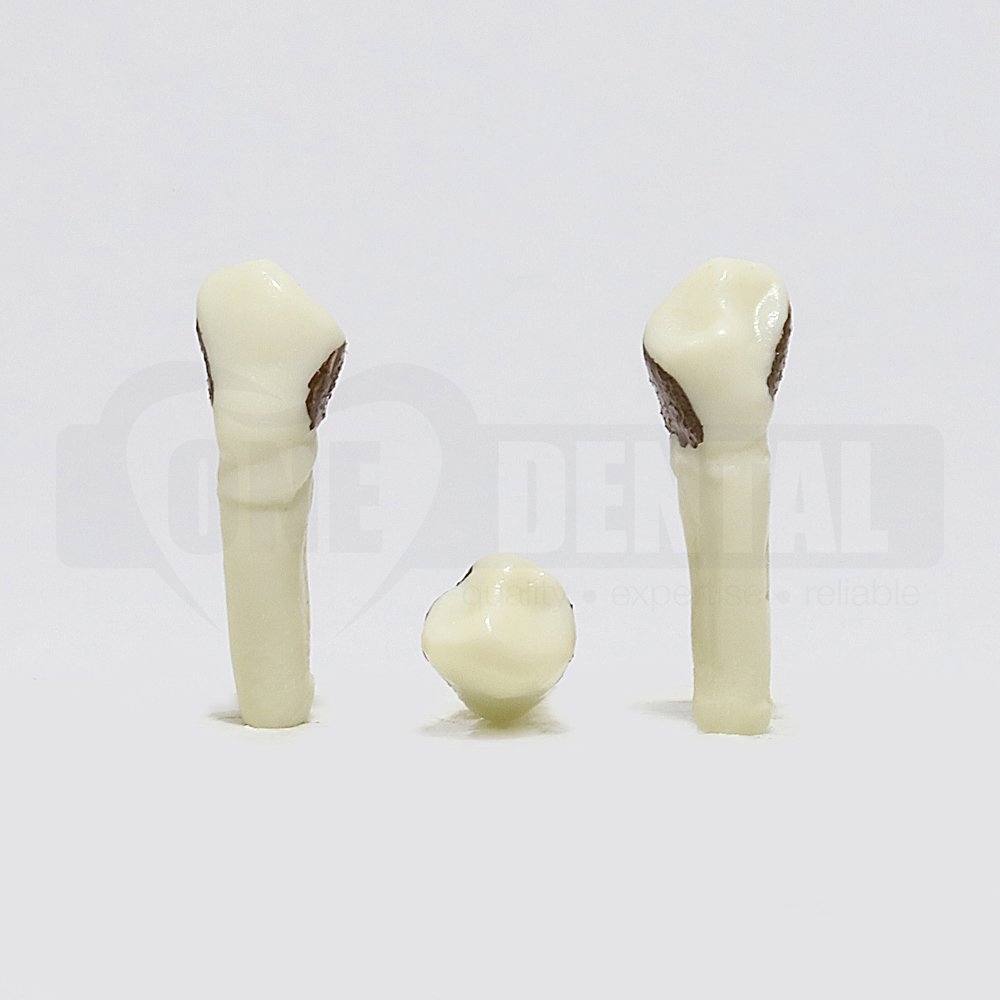 Periodontic Tooth 34