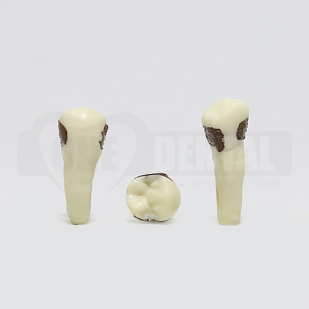 Periodontic Tooth 35