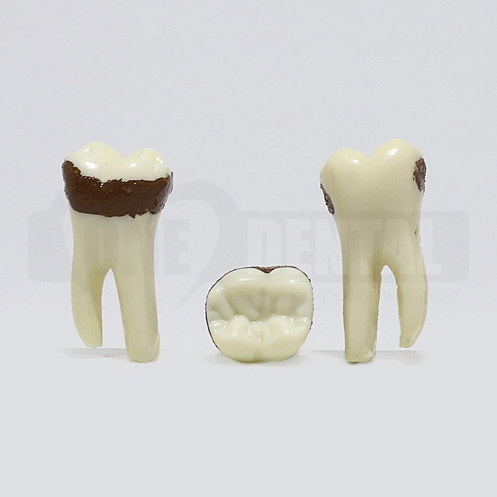 Periodontic Tooth 36