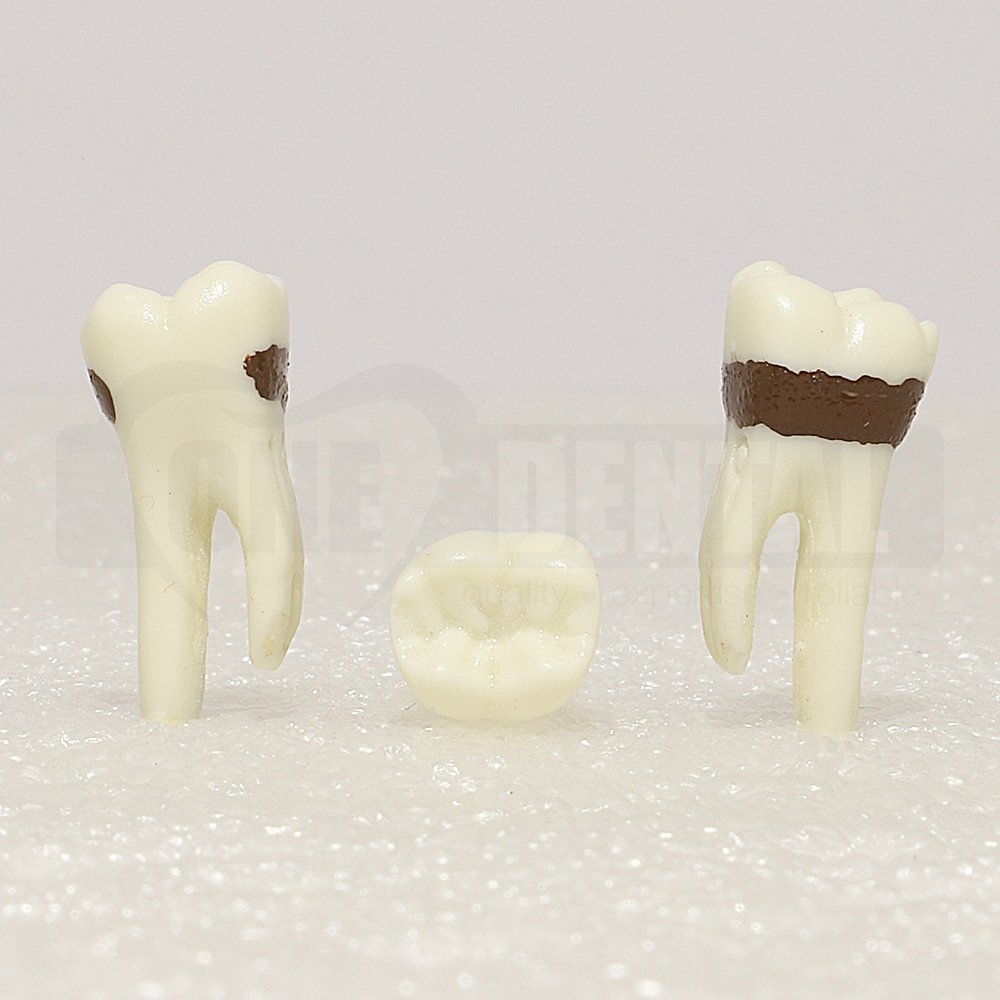 Periodontic Tooth 36 Spahr 19