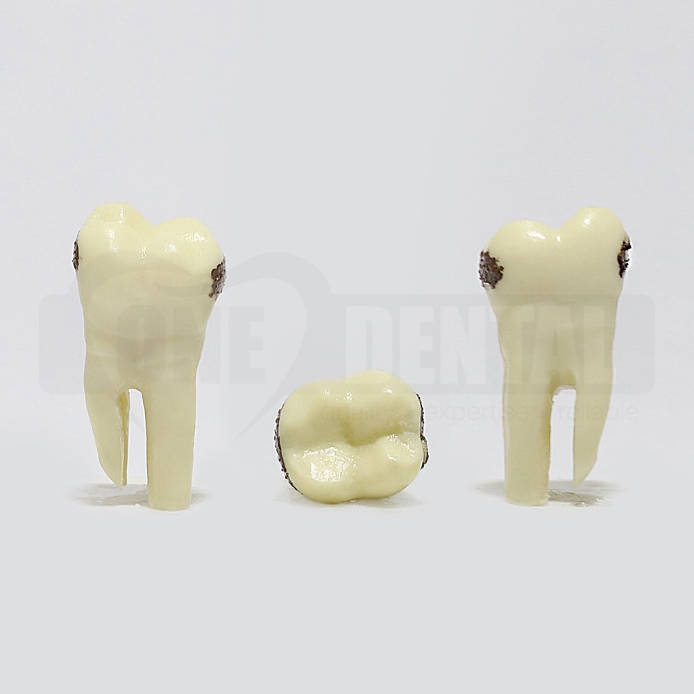 Periodontic Tooth 37