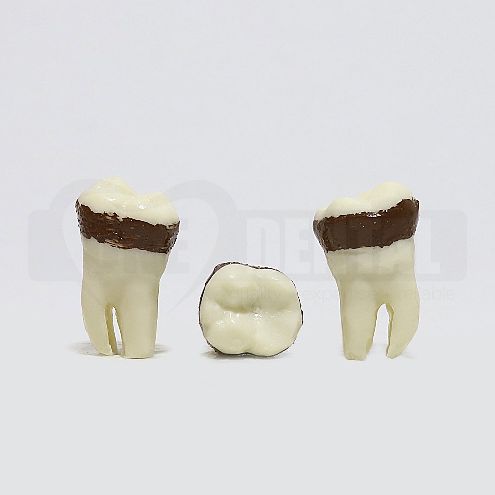 Periodontic Tooth 38