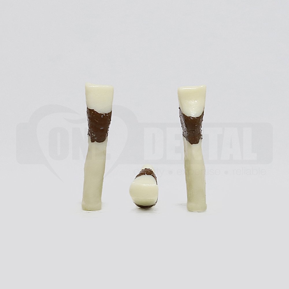 Periodontic Tooth 41