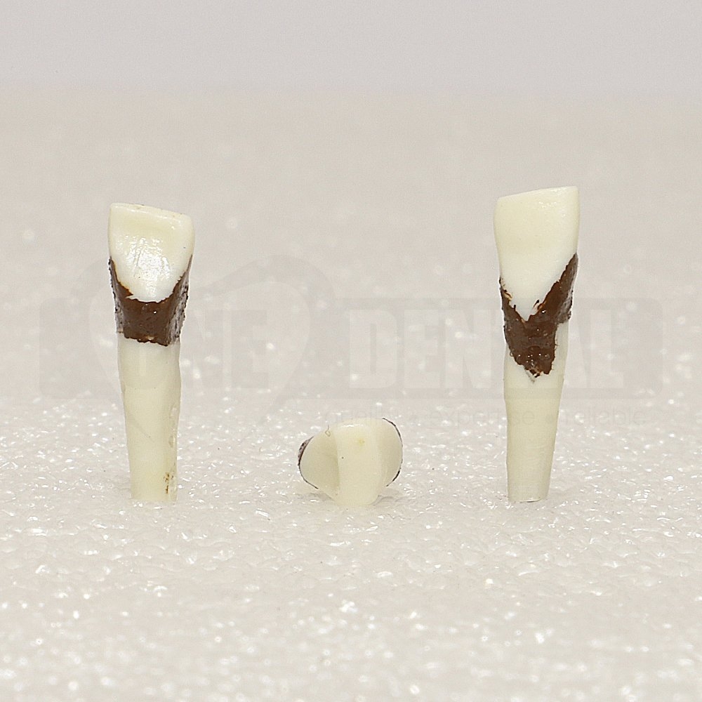 Periodontic Tooth 43 Spahr 19
