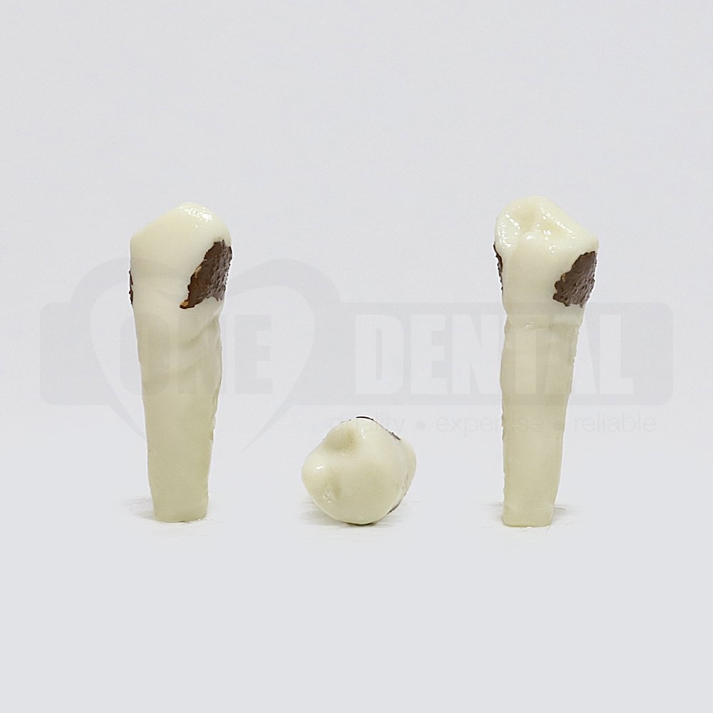 Periodontic Tooth 44