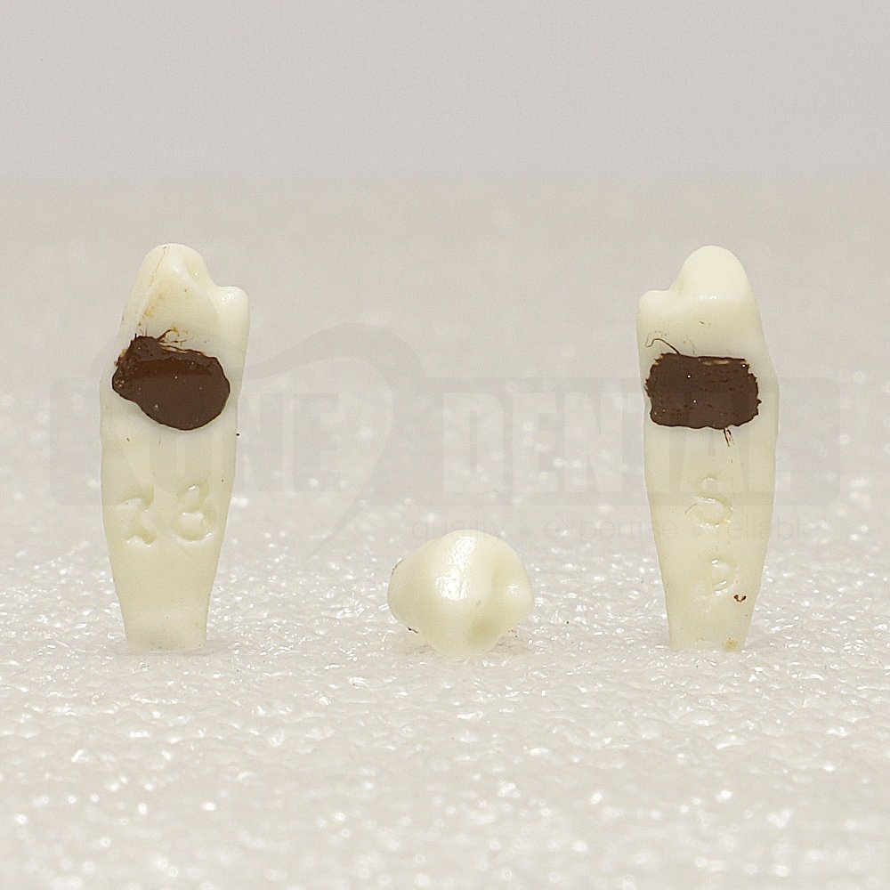 Periodontic Tooth 44 Spahr 19