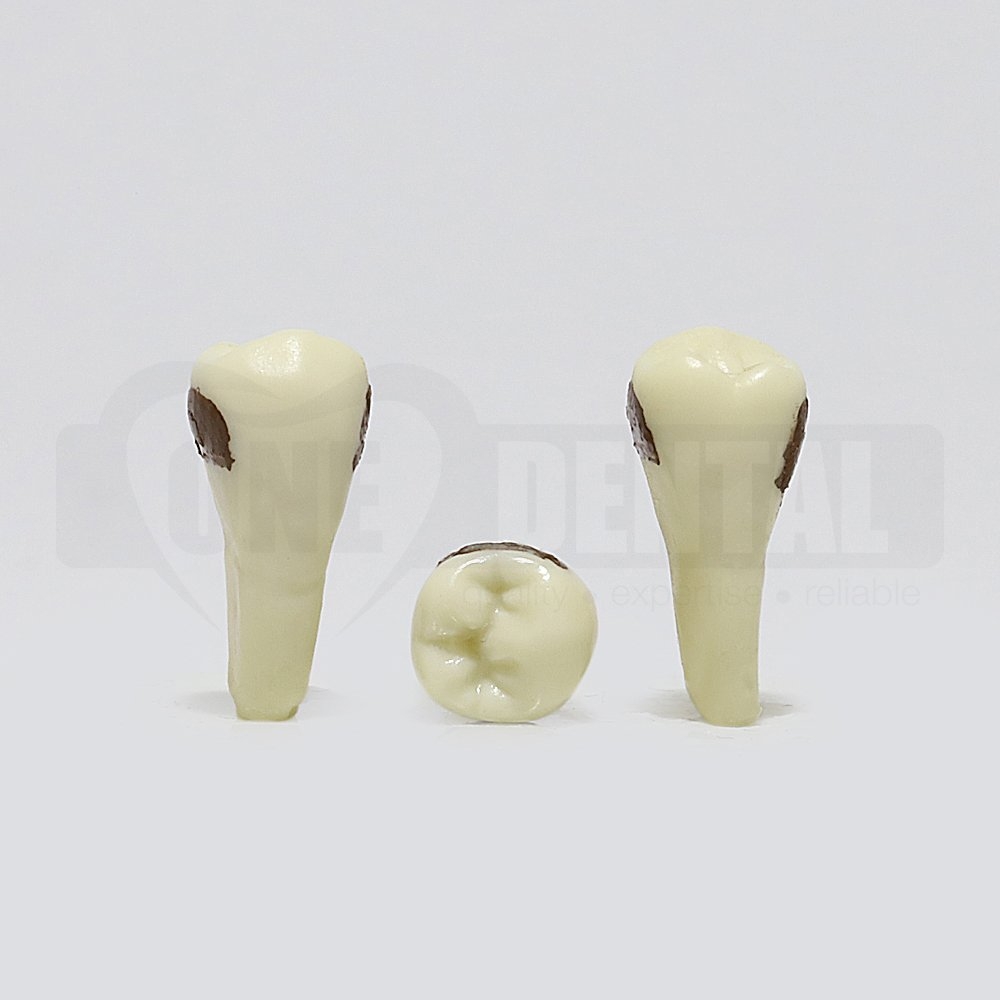 Periodontic Tooth 45
