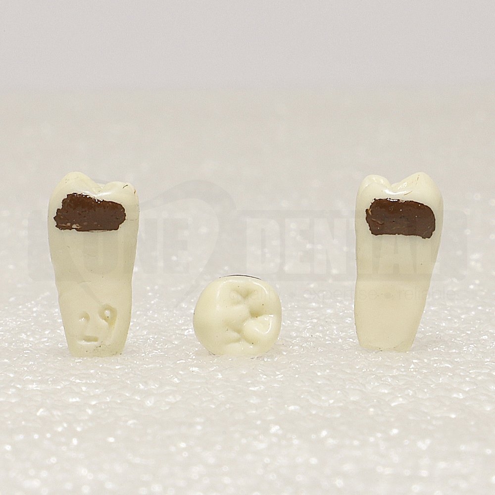 Periodontic Tooth 45 Spahr 19