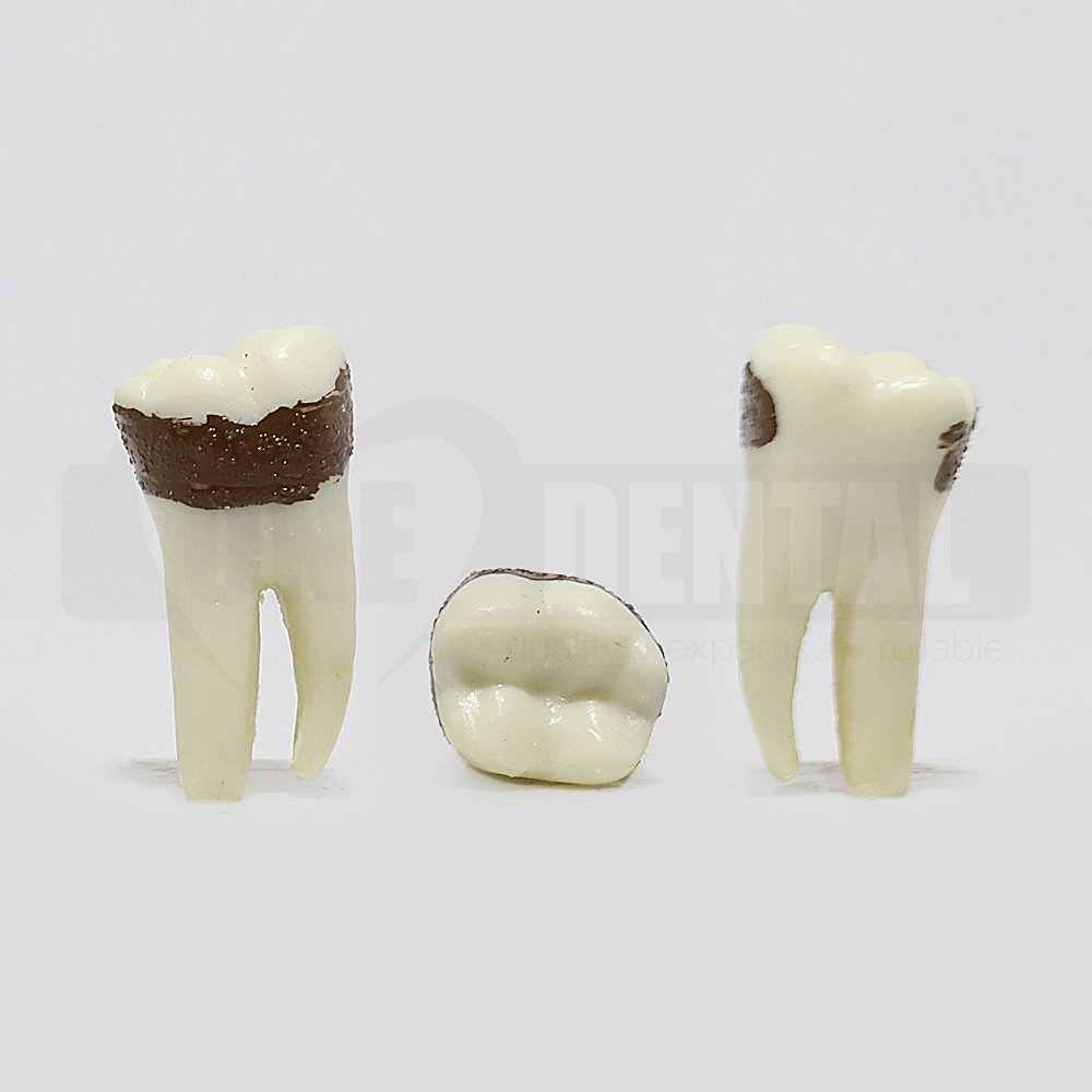 Periodontic Tooth 46