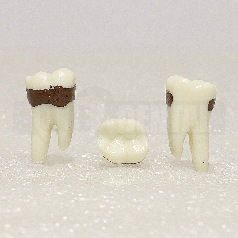 Periodontic Tooth 46 Spahr 19