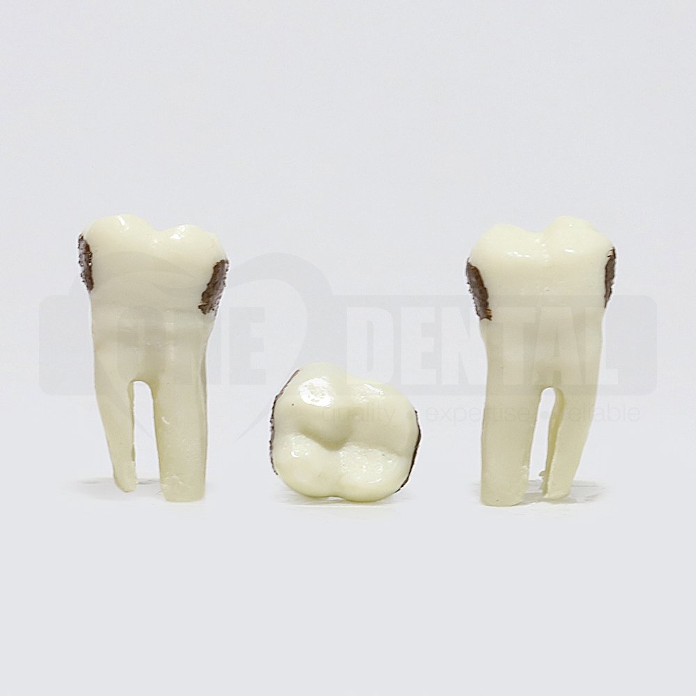 Periodontic Tooth 47
