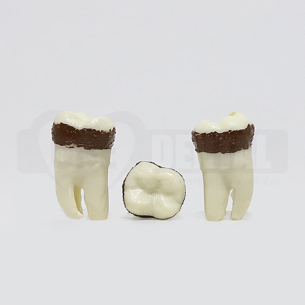 Periodontic Tooth 48