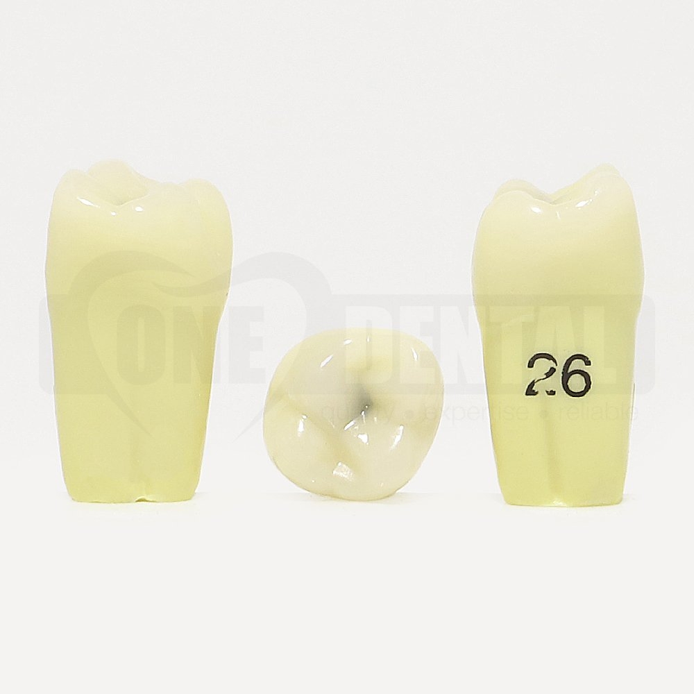 Caries Tooth 26 Occ GW for Paedo Model 1971