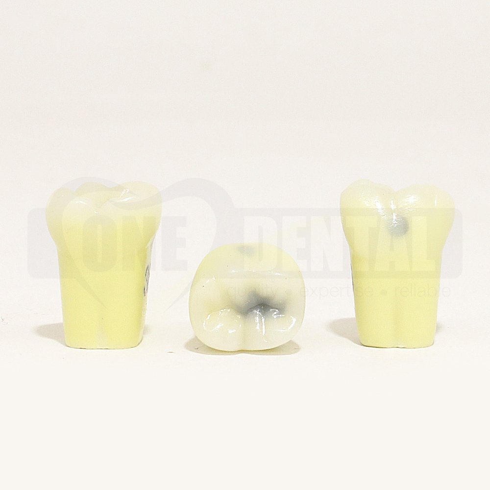 Caries Tooth 36 MOB for 1971 Paedo Model