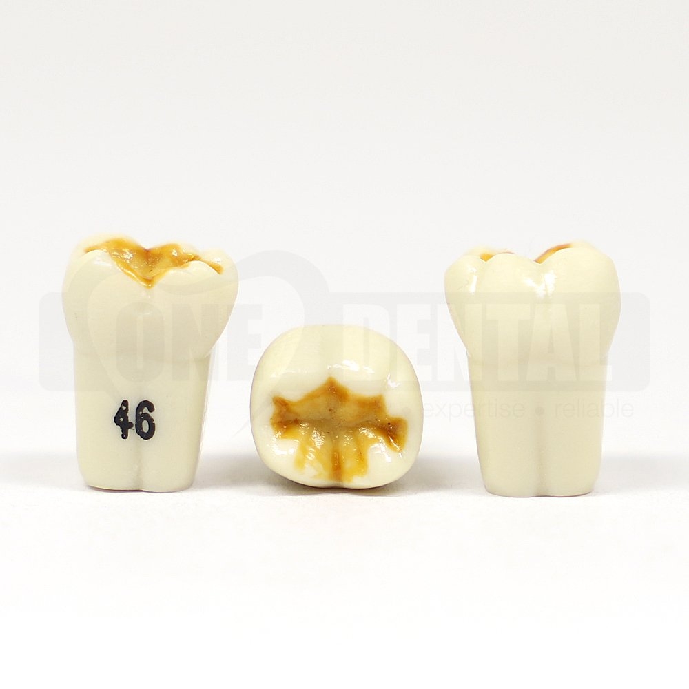 Hypomineralised Tooth 46 for 1971 Paedo Model