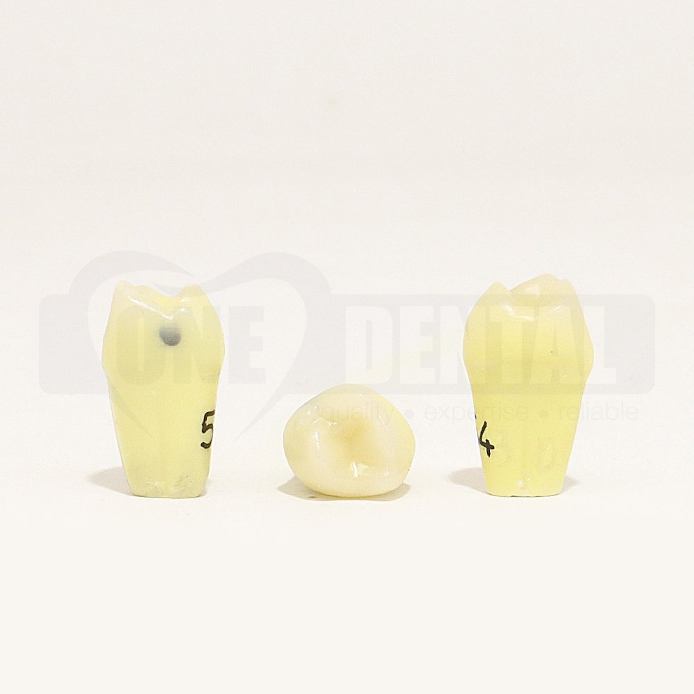 Caries Tooth 54 Distal for 1971 Paedo Model