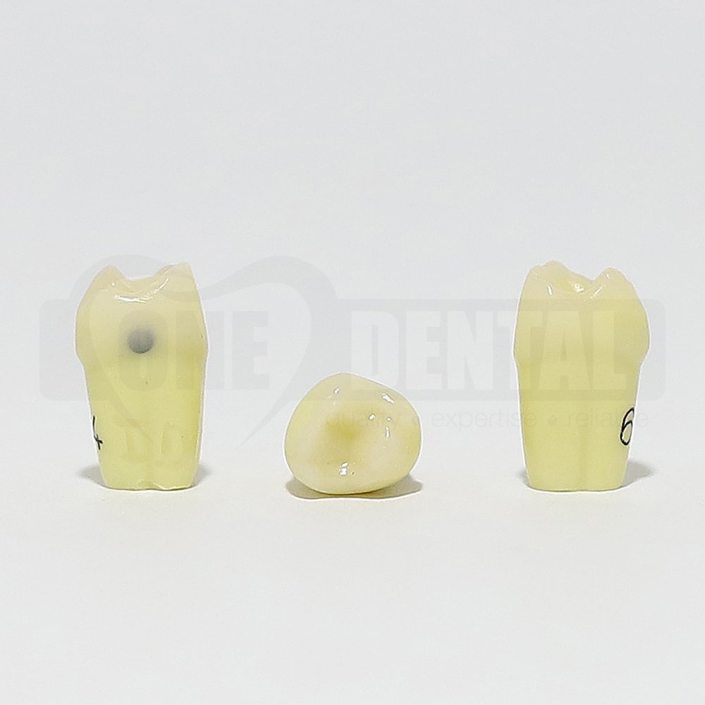 Caries Tooth 64 Distal for 1971 Paedo Model