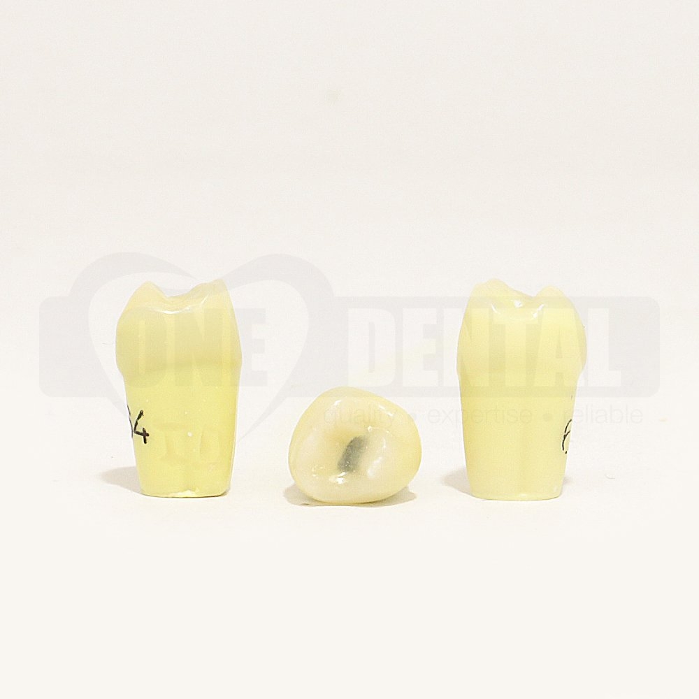 Caries Tooth 64 Occ for 1971 Paedo Model