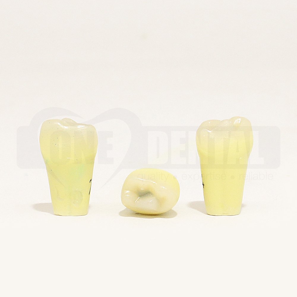 Caries Tooth 74 Occ for 1971 Paedo Model
