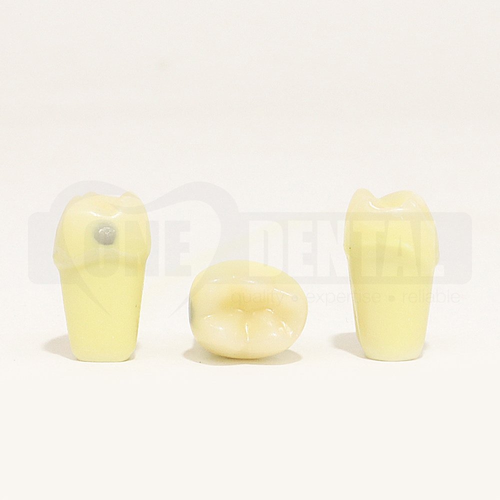 Caries Tooth 75 Occ for 1971 Paedo Model