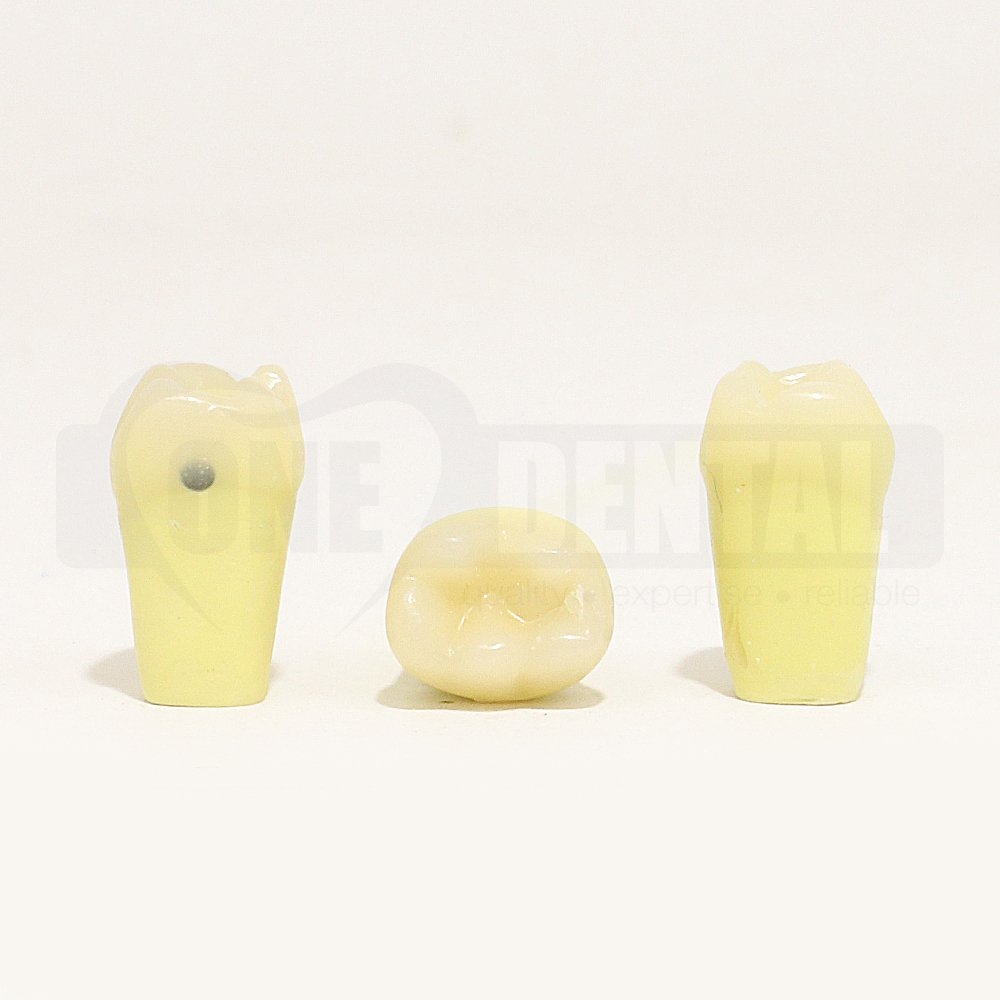 Caries Tooth 85 Mesial for 1971 Paedo Model