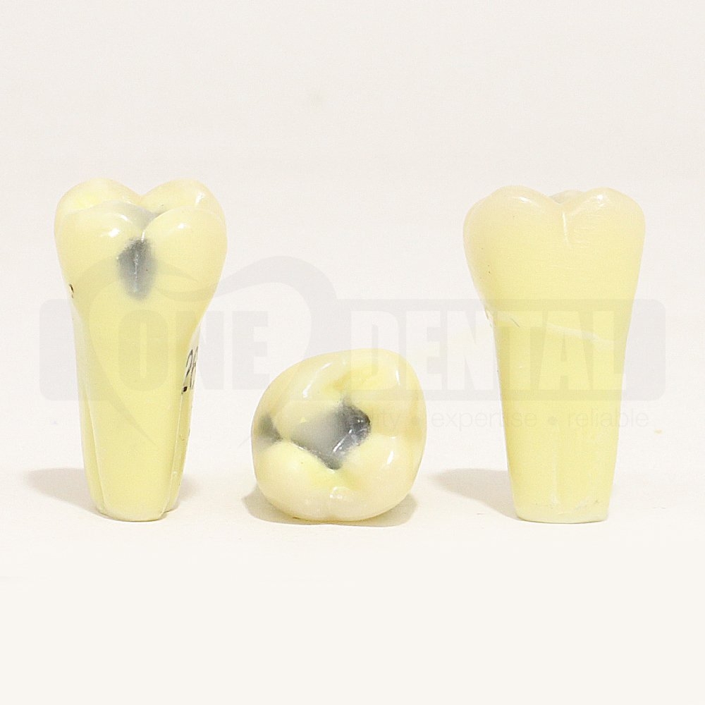 Caries Tooth 26 OL for Paedo Model 1971