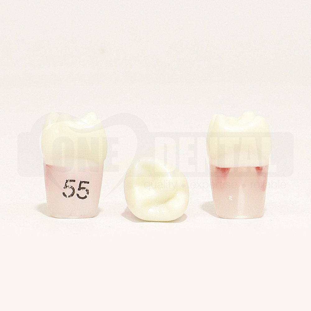Pulpotomy Tooth 55 + Screw for 1974 Paedo Model