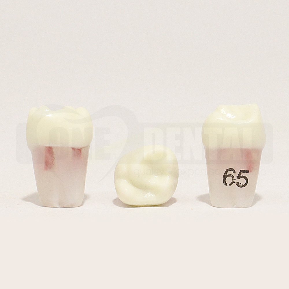 Pulpotomy Tooth 65 + Screw for 1974 Paedo Model