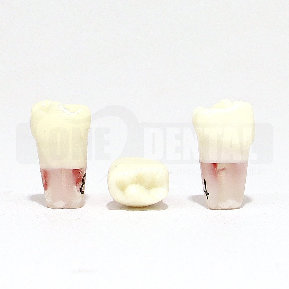 Pulpotomy Tooth 84 + Screw for 1974 Paedo Model