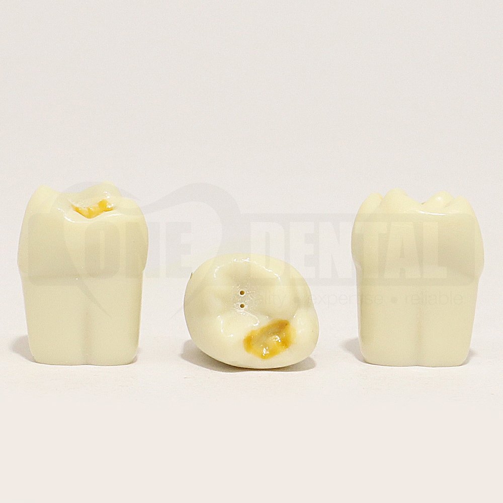 Hypomineralised Tooth 16 DM for 1974 Paedo Model