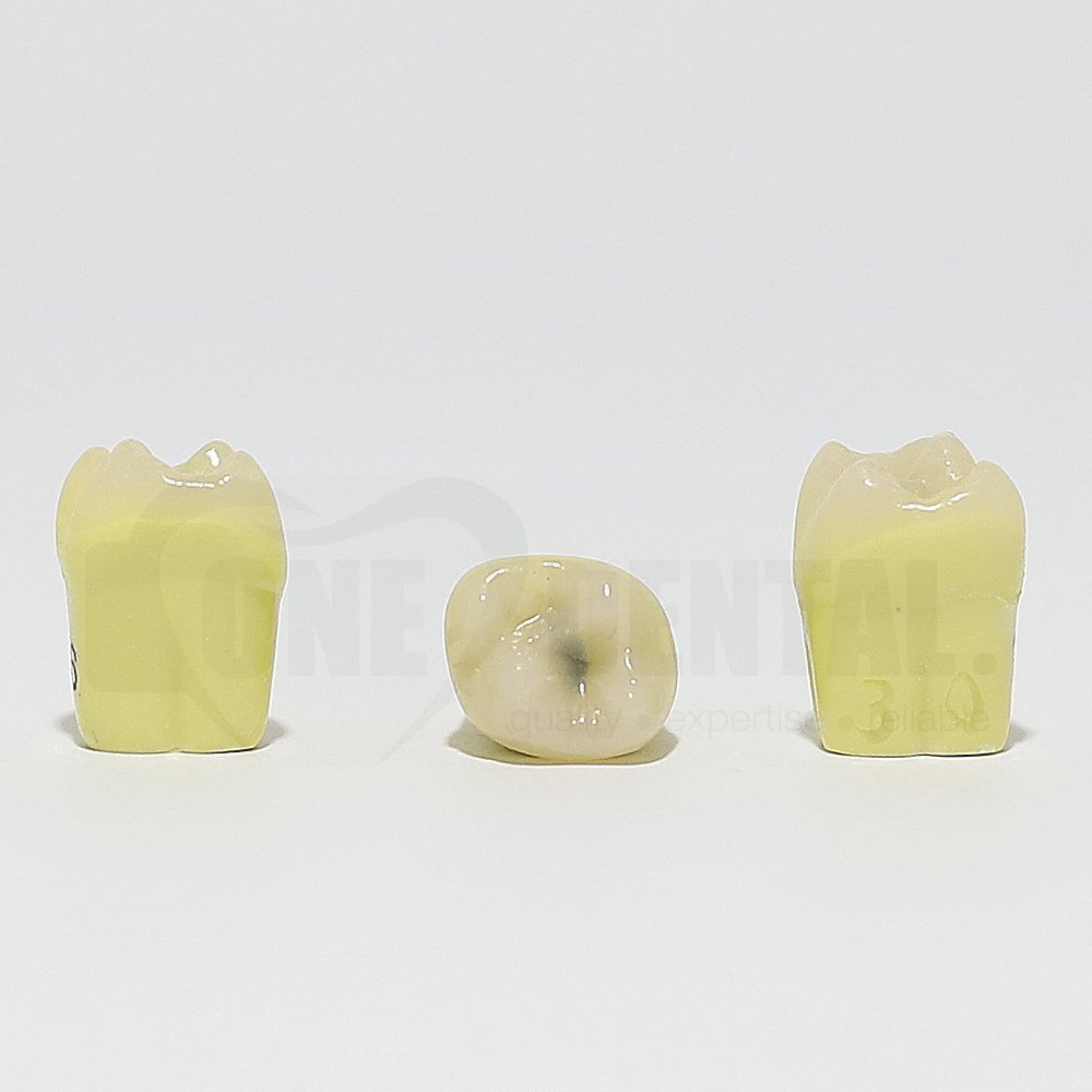 Caries Tooth 16 Occ for 1974 Paedo Model