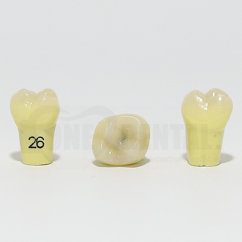 Caries Tooth 26 Occ for 1974 Paedo Model