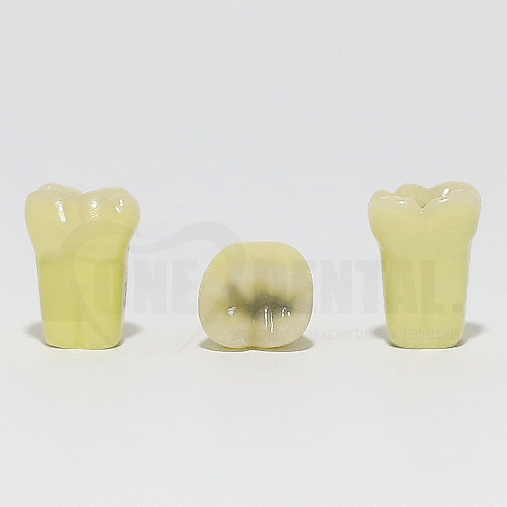 Caries Tooth 36 Occ for 1974 Paedo Model