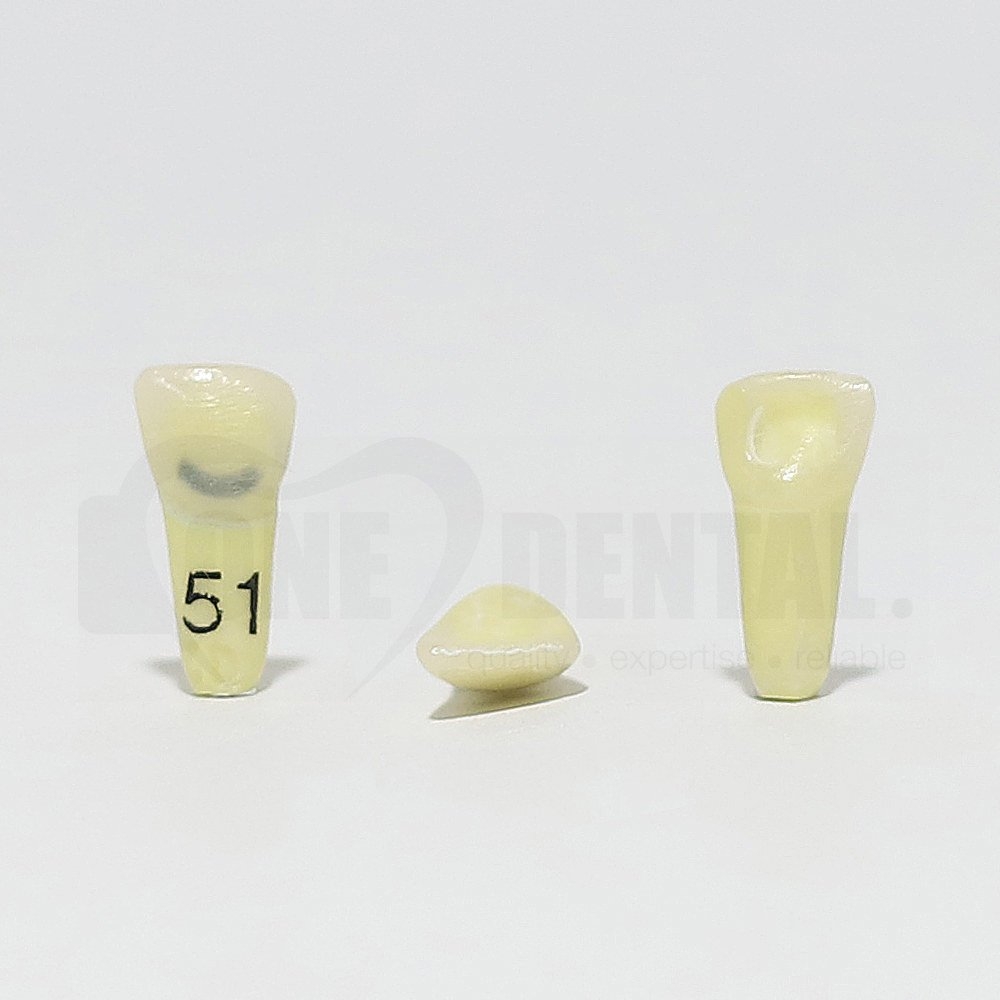 Caries Tooth 51 Cervical for 1974 Paedo Model